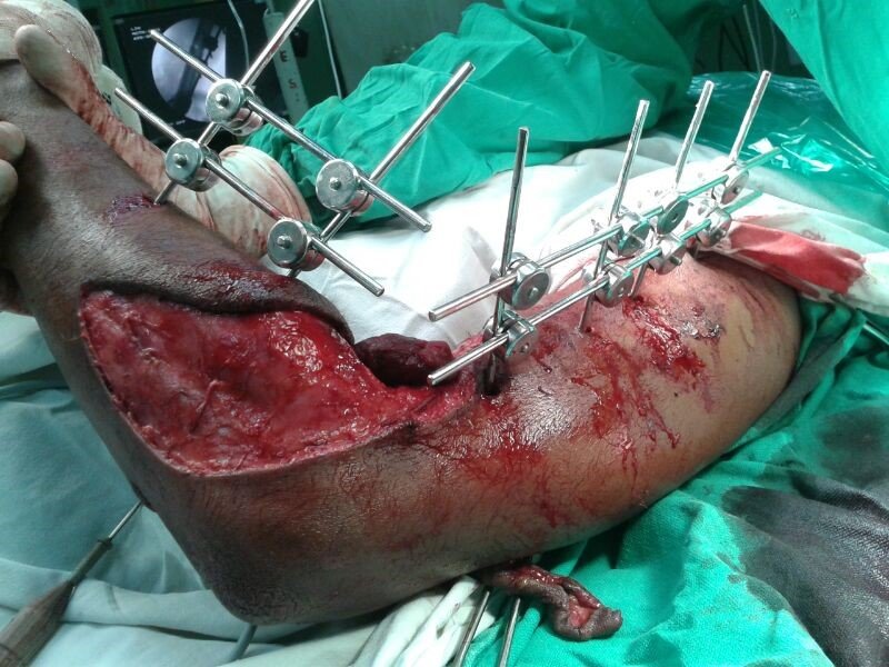 Partial Hand Amputation