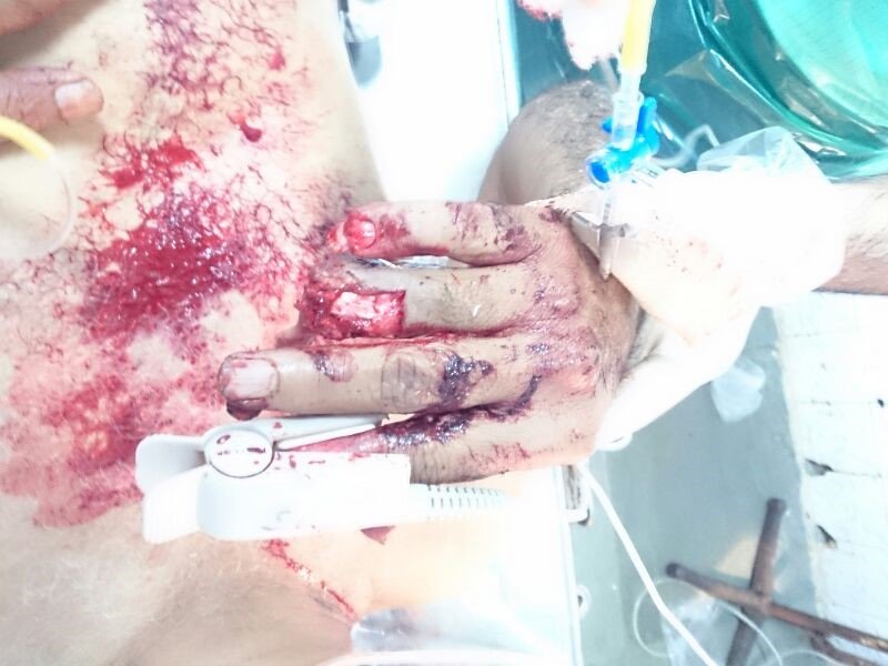 Ankle Reconstruction