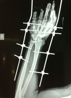 Femur Fracture Repair