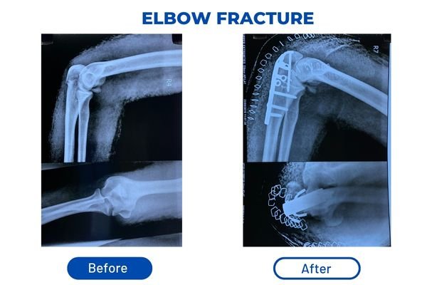 Fracture Aftercare Image 1