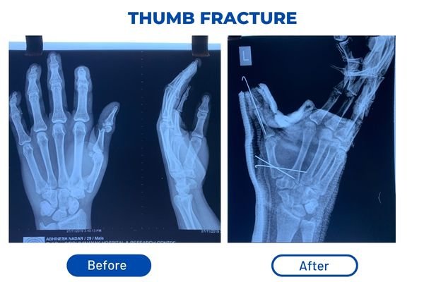Fracture Aftercare Image 2