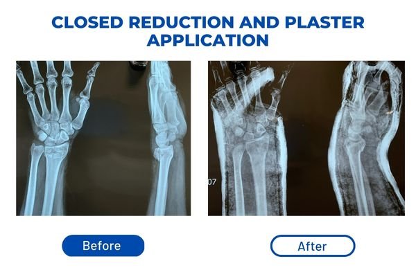 Fracture Aftercare Image 2