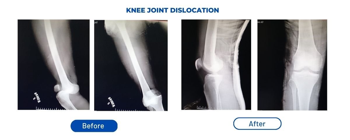 Fracture Treatment Surgery