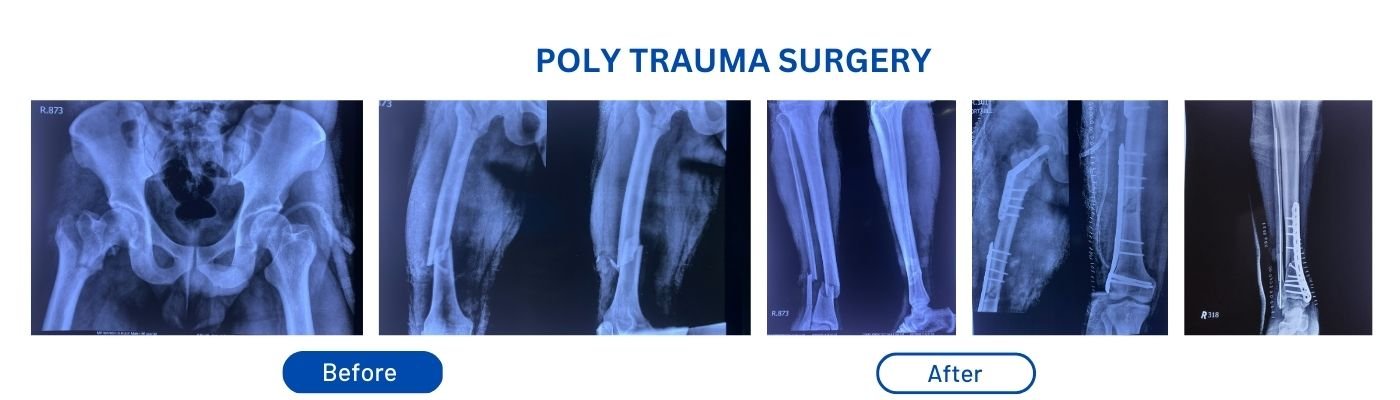 Fracture Treatment Surgery