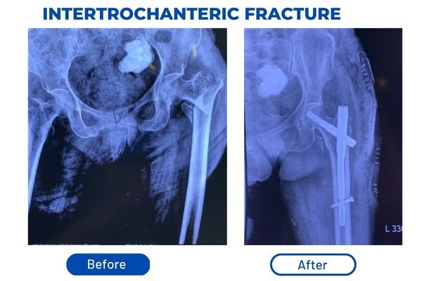 Fracture Aftercare Image 1