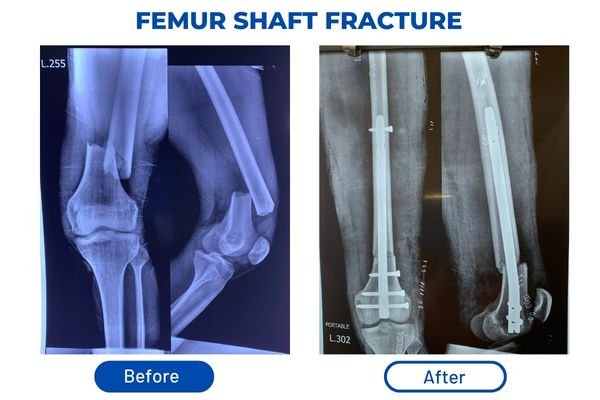 Fracture Aftercare Image 2