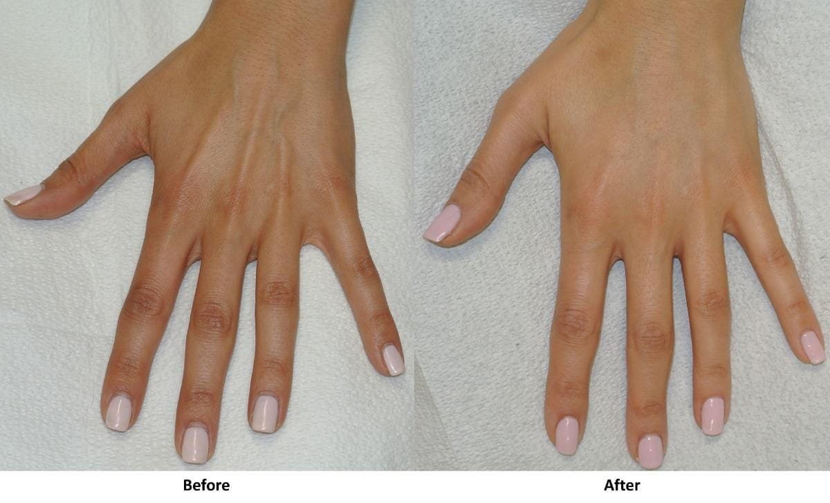 Hand Rejuvenation