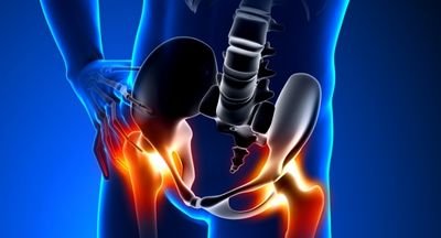 Hip Replacement Surgery