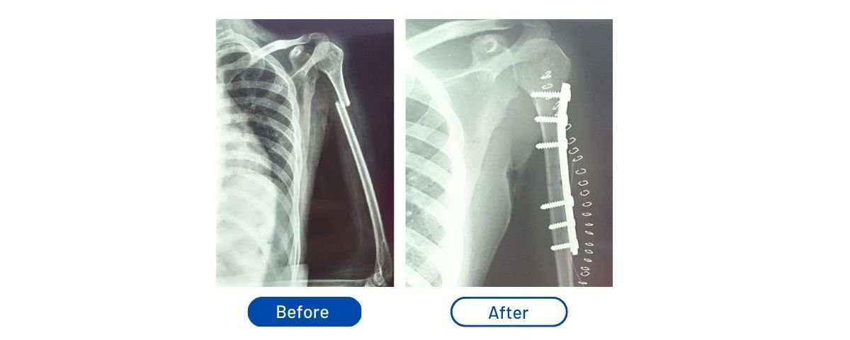 Humerus Fracture
