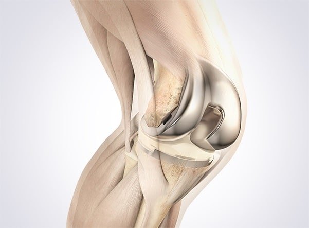 Partial Knee Replacement
