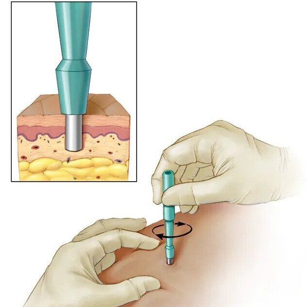 Skin Biopsy
