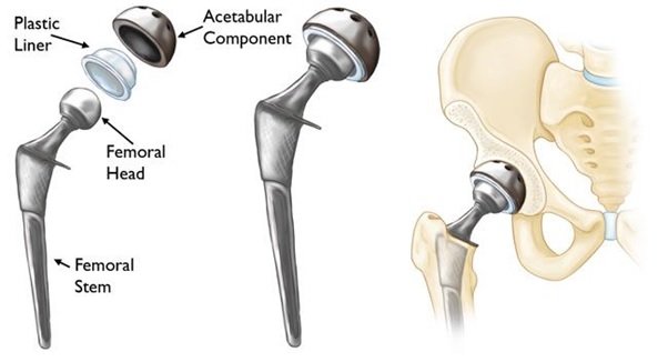 Hip Replacement Components