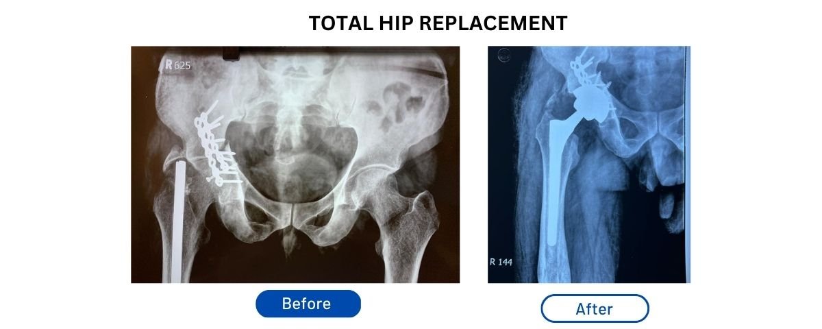 Post Surgery Activity